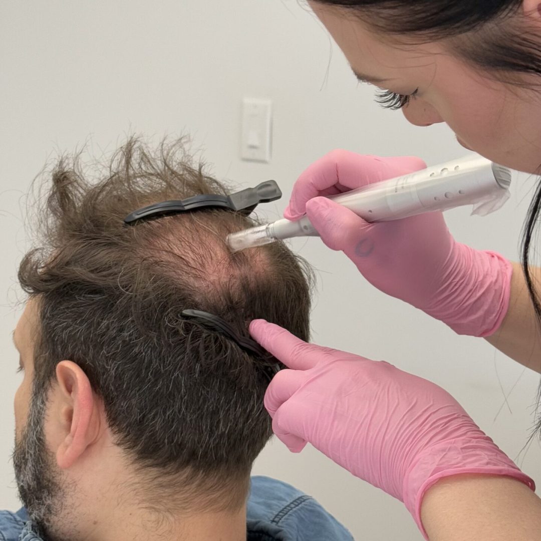 Hair Restoration Hair Restoration with Exosome Therapy