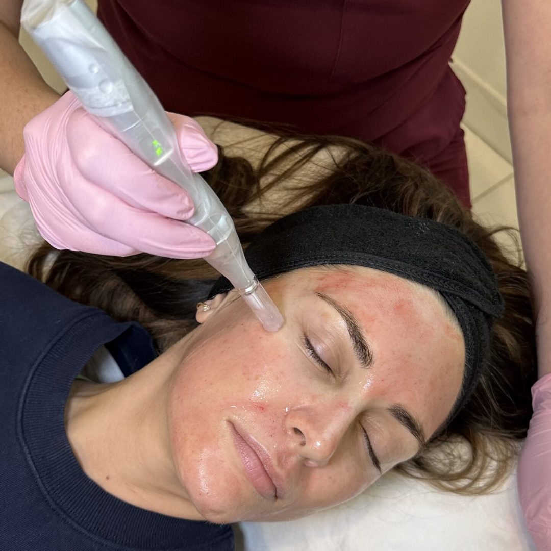 Microneedling Microneedling