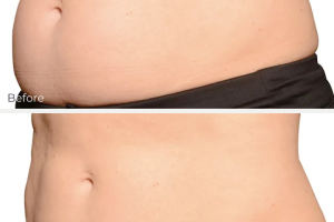 Skin Treatments CoolSculpting Before and after coolsculpting treatment at CML